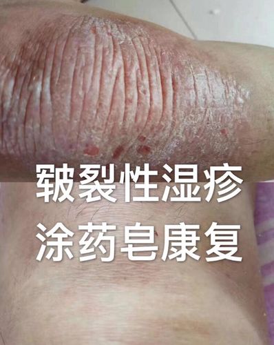 白癜风,牛皮癣,红斑狼疮,湿疹(皲裂性湿疹),荨麻疹,带状疱疹,斑丘疹