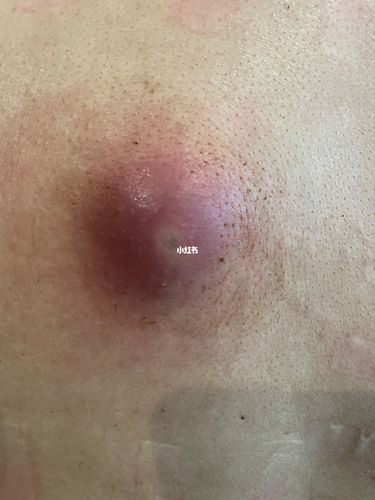 一个皮脂腺囊肿的惨痛经历_发炎_痛经_引流_nurofen怎么样_软膏_碘伏