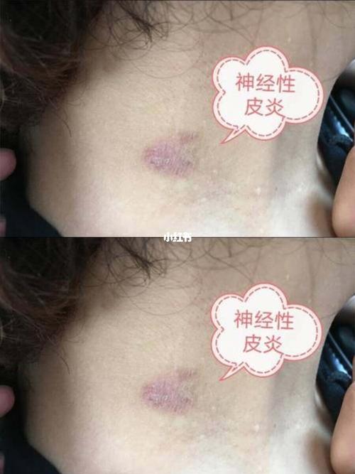 神经性皮炎 脖子上面也不知道是怎么回事那个样子了,我以为过几天就
