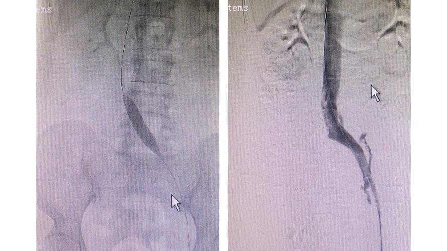 髂静脉压迫综合征cockettsyndrome诊治经验及典型病例集锦