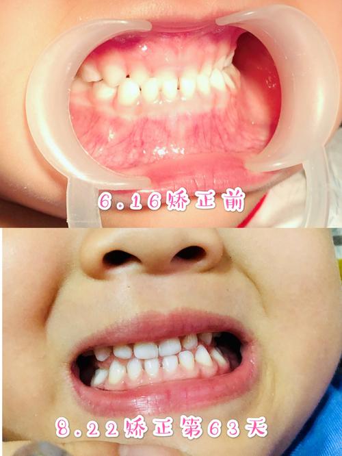儿童地包天牙齿矫正效果对比6015_儿童牙齿矫正_母婴_育儿经验