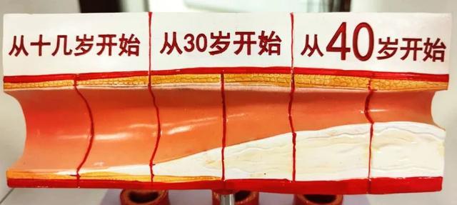 血管横截面示意图 当血管发生老化时,管壁增厚,不光滑,出现不同厚度