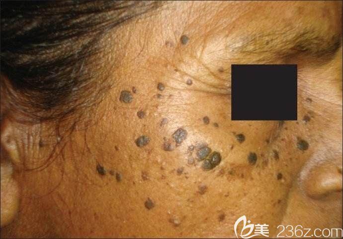 除省钱偏方外还有皮秒激光这种老年斑的治疗方法又快又方便