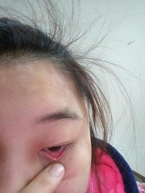 下眼皮里面长了个小白点两年多啦不疼不痒