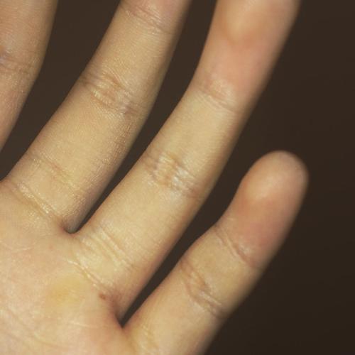 自从遇见他,左手无名指根部长出一颗痣,左手手背相应地方从小就有颗
