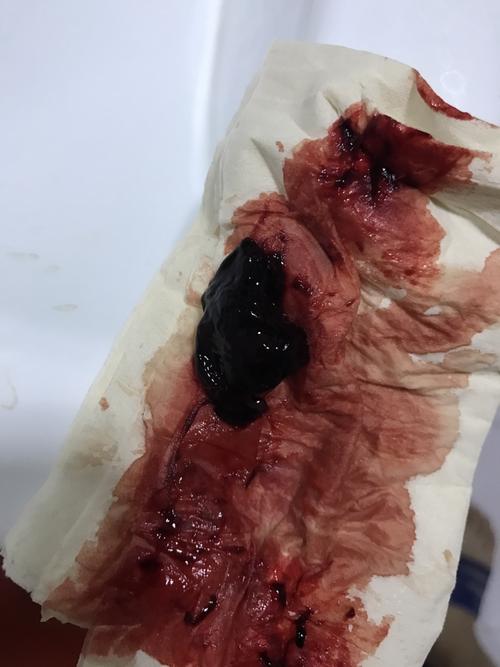 边缘性前置胎盘,月初少量出血住院观察了,后面也断断续续的少量