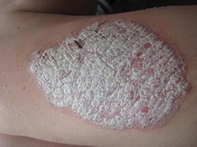 牛皮癣是目前在人们肌肤上出现频率比较高的1种慢性皮肤病顽疾,牛皮癣