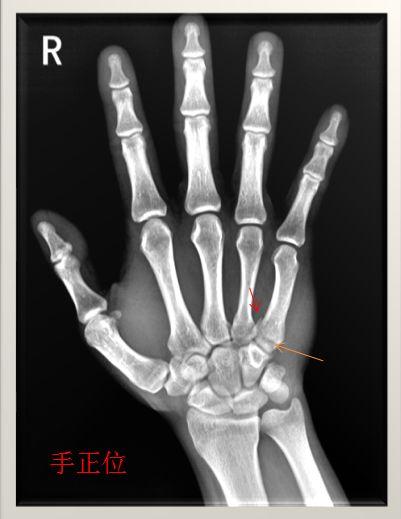 病例2,诊断为右手第五掌骨基底部骨折.