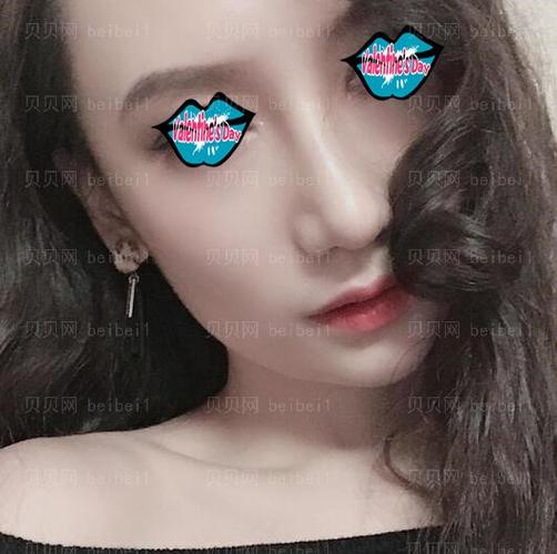 重庆艺星整形医院张龙鼻综合整形案例
