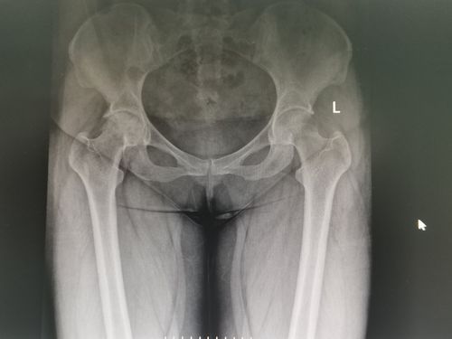 dr片示:右侧股骨头形态完整,内密度不均匀,可以多发斑片状低密度影,髋