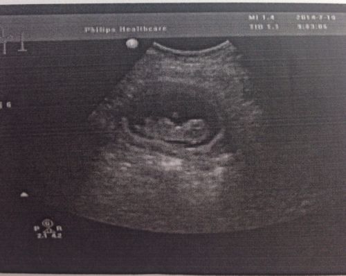 怀孕11周做的彩超,各位能不能看出是男宝还是女宝?