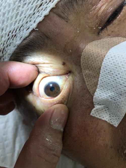 大面积脑梗死颅内内减压术后,双眼瞳孔直径立刻恢复正常.