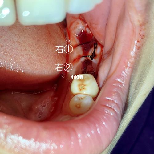81566拔烂牙根,位点保存→3个月后再种植_止痛药