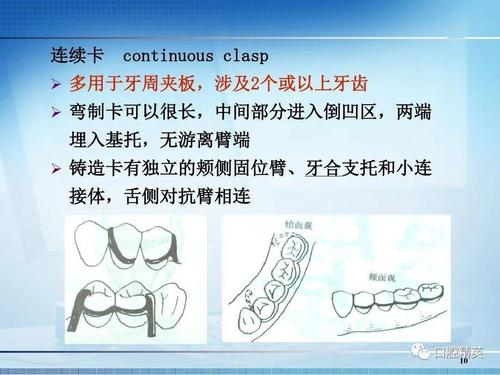 可摘局部义齿卡环的种类