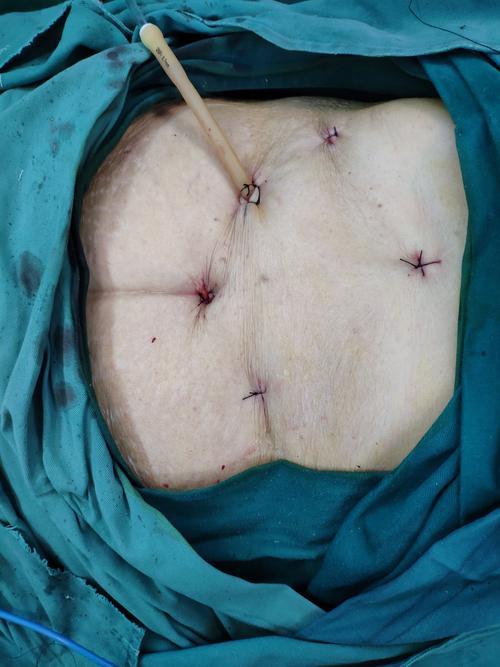 腹腔镜微创手术切口