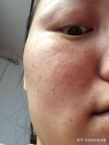 脸颊底层的疙疙瘩瘩的都出来了