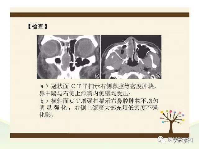 十余种鼻和鼻窦病变ct诊断要点丨影像天地