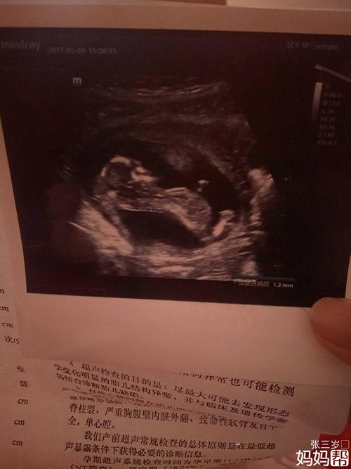 宝妈们谁照了11周的彩超发个图看看呗