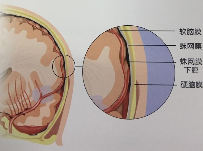 蛛网膜下腔出血
