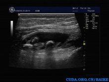 大小不等,最大直径可达数厘米,游离体呈圆形,椭圆形,桑葚形,随关节