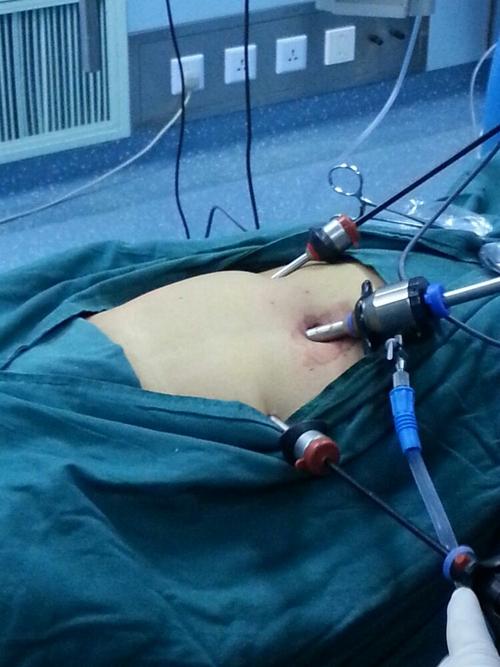 我们结合病人情况选择术式,这是为一位直疝患者行tapp术,戳卡位置.