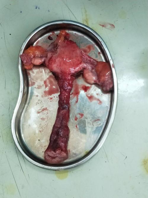 术式:阴式子宫全切 双侧附件切除术 阴道前后壁修补术