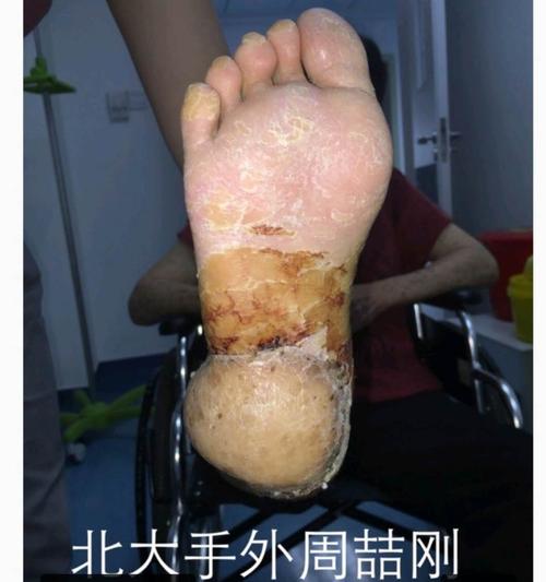 足底黑色素瘤的保肢手术 有图有真相