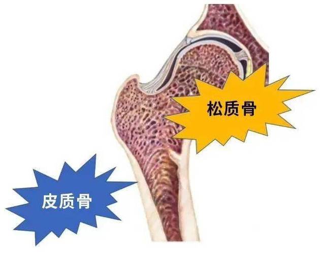 皮质骨相当于饺子皮,松质骨相当于饺子馅,皮厚馅多的时候,意味着骨头