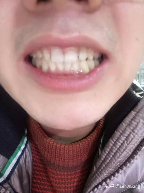 长沙市口腔医院门牙(根尖囊肿)种植暨漫长寻医之旅