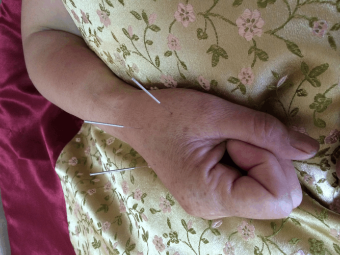 灵骨大白反后绝穴应用经验(验案五则)