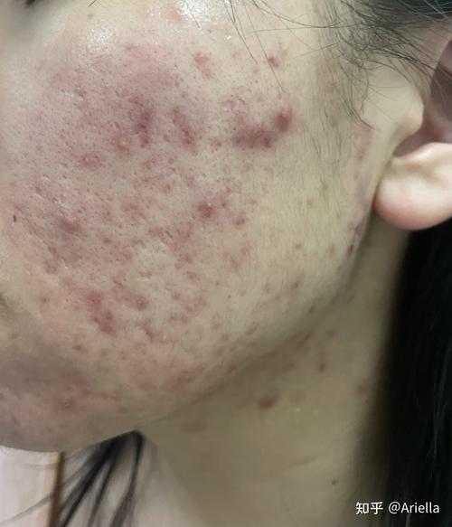 15岁的女生不能刷酸消除痘或痘印吗父母不支持怎么办