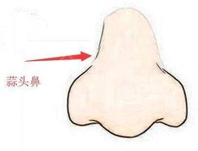 肉鼻头,人们俗称的蒜头鼻,其实就是鼻头和鼻翼肥大,所以整个鼻头看