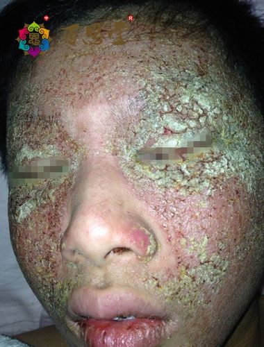 面部特应性皮炎怎么治疗方法有效?重症记录中