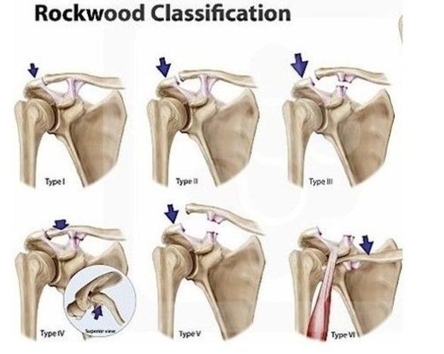 图解肩锁关节脱位的治疗选择