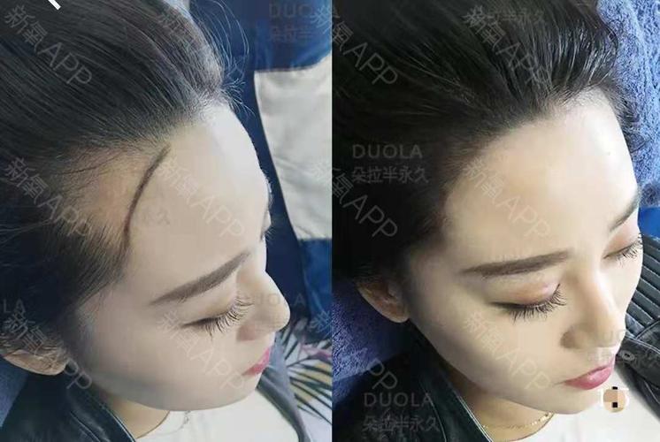 半永久纹发际线怎么样_恢复过程_效果如何_氧气mam6bd2整形日记11.
