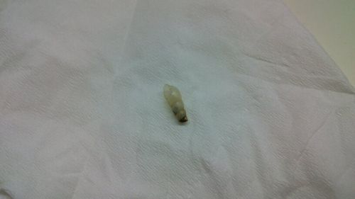 我是男的,17岁,大概2年前开始发现内裤裏长黑点,2层布