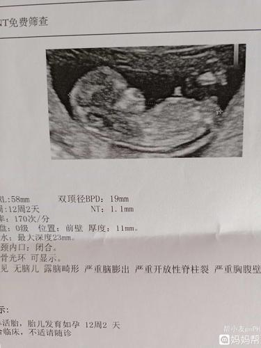 刚做的nt,一次通过,医生说结果很不错!
