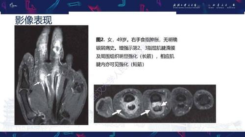 银屑病关节炎影像诊断