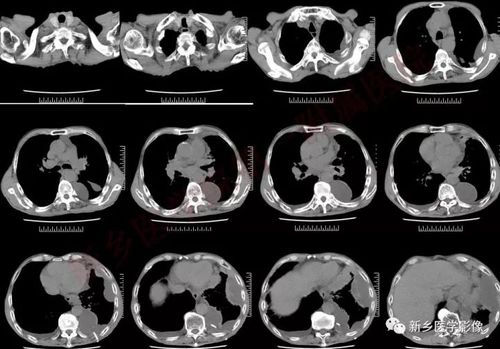 病例小细胞肺癌1例ct影像表现