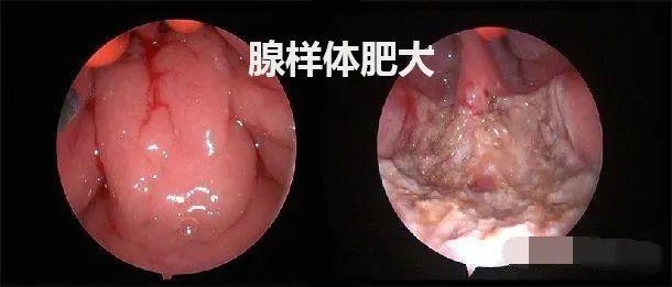 扁桃体的炎症波及发生病理性增生,也就是我们通常所说的腺样体肥大