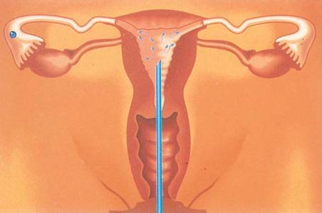 子宫内膜异位症可以做人工受精吗?