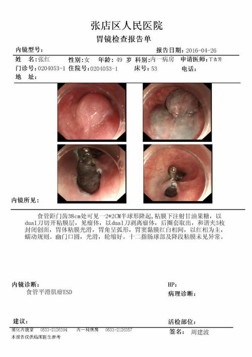 食管平滑肌瘤esd治疗1例(附病理报告)