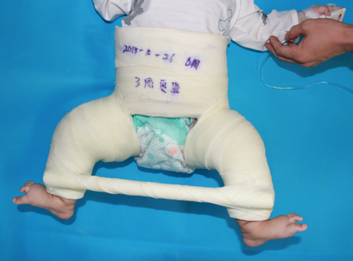 髋关节发育不良,随着孩子长大,能自己好转吗?