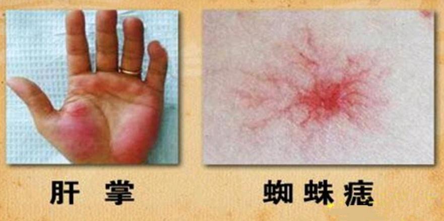 手掌蜘蛛痣