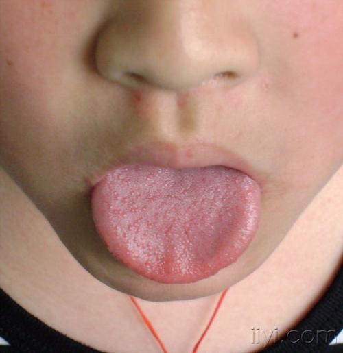 最近猩红热很多,请大家注意点(附图)!