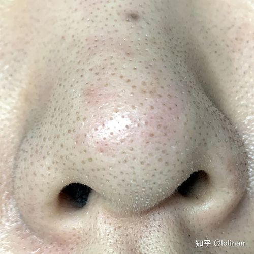想问问大家,如何在不损伤毛孔的情况下去掉黑头?