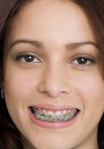 带着牙套微笑的美女