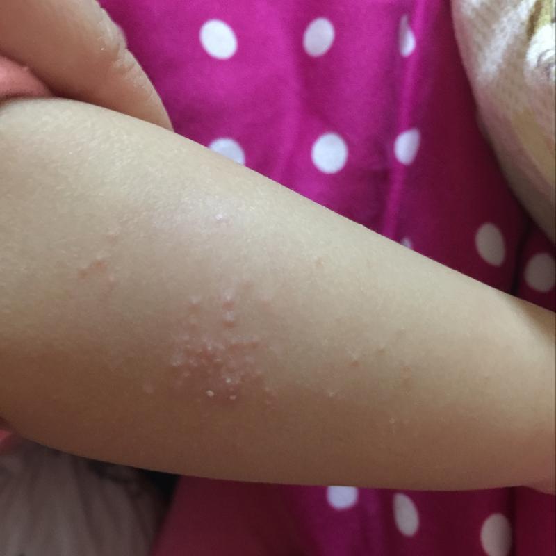 宝宝胳膊上长了这种小疙瘩,谁能帮我看看是怎么了?