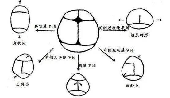 宝宝的头大,头小,偏头,方颅,是什么原因?一次性弄清楚