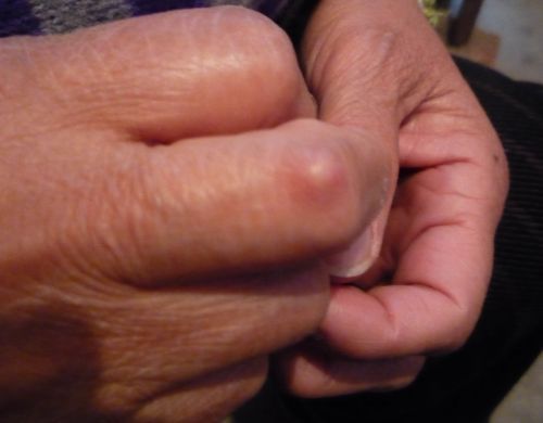 手指腱鞘炎的病因